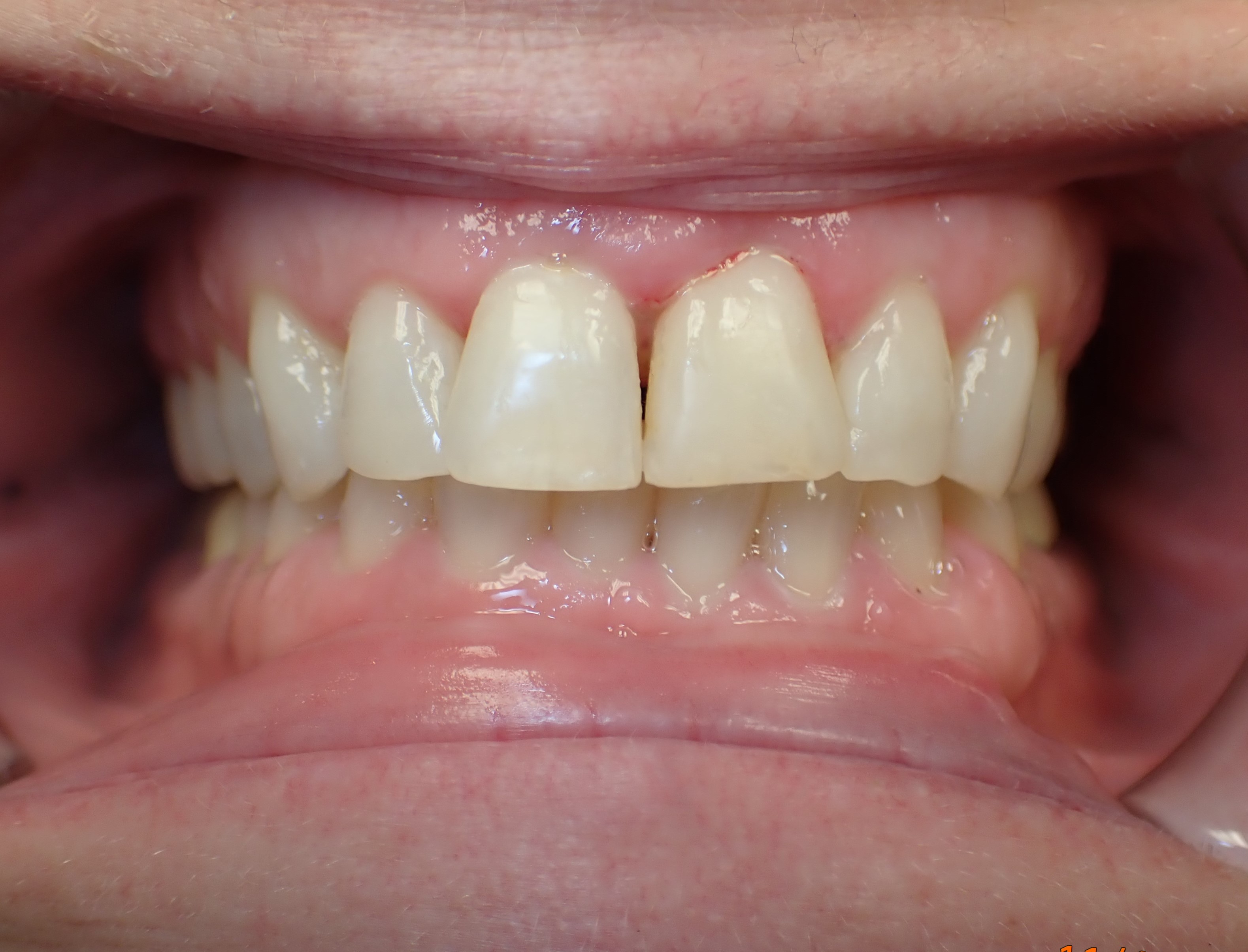 Close shot of teeth