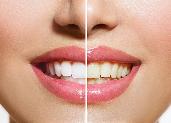 Smile before and after teeth whitening
