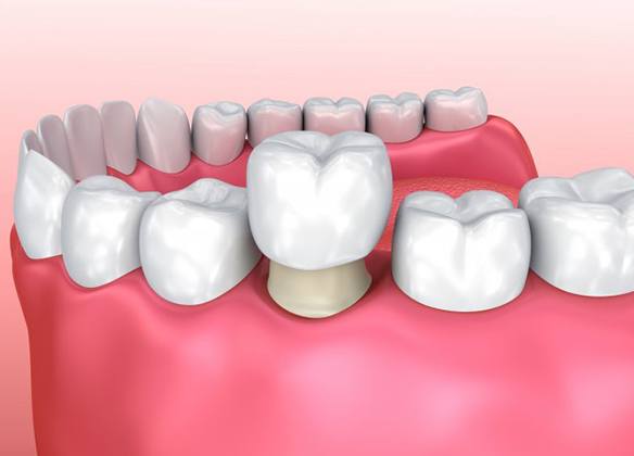 diagram of dental crown being placed over tooth