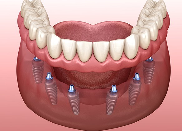 Digital image of an implant denture