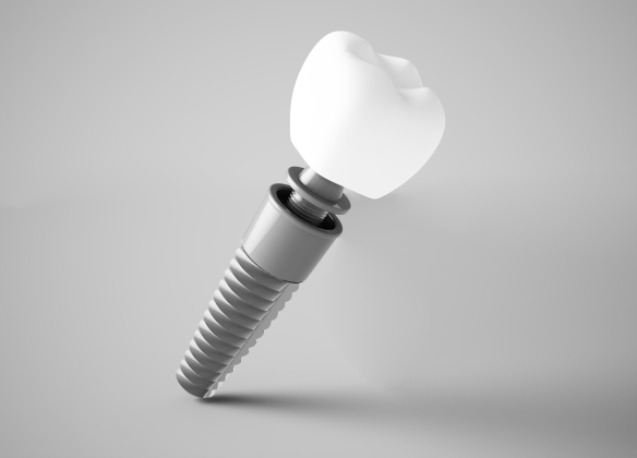Animated dental implant with crown