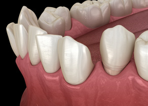 Illustration of crooked teeth