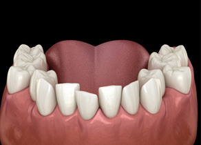 Illustration of gapped teeth