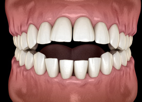 Illustration of an open bite