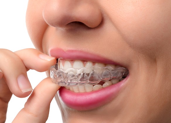 Woman putting in a clear Invisalign tray 