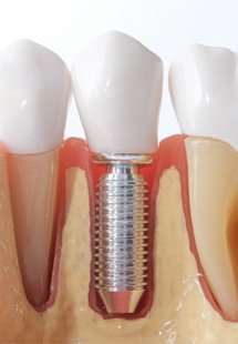 Model of a dental implant and teeth