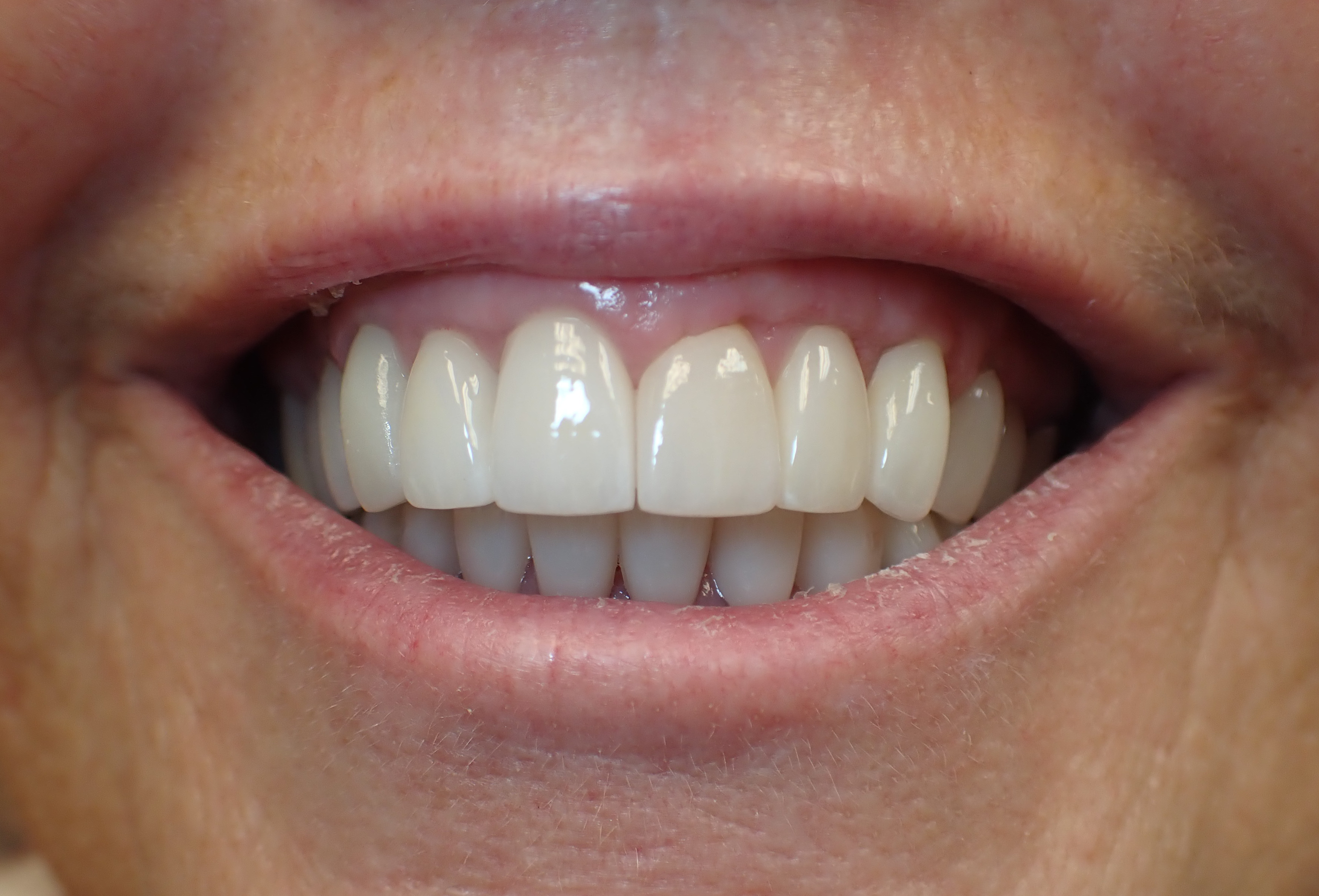 Smile improved by veneers