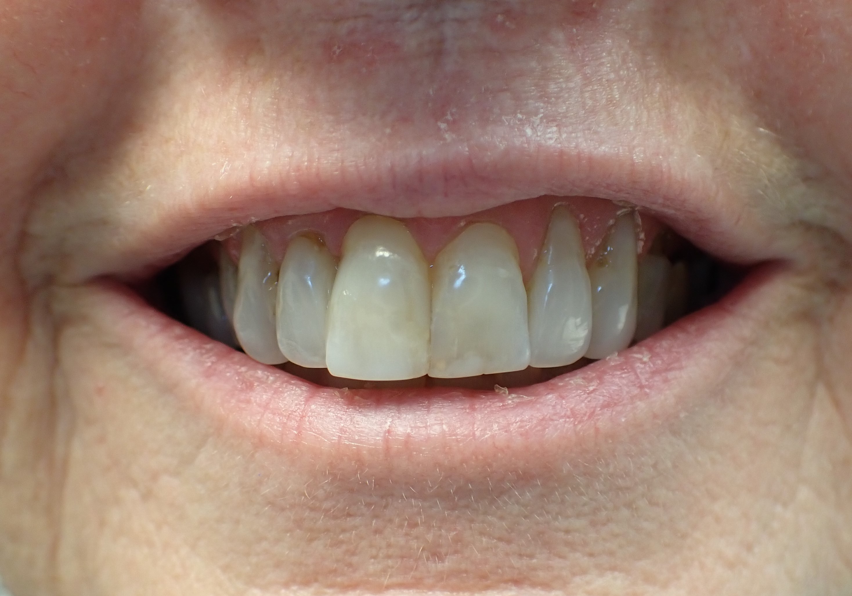 Close up of teeth after veneers have been placed