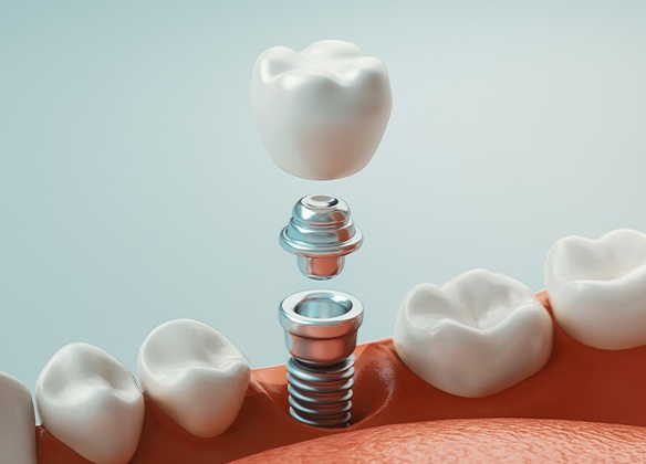 Animated dental implant being placed in lower arch
