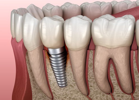 Illustration of infected tissue around a dental implant