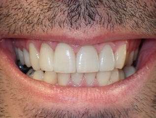 Close up of a much brighter smile