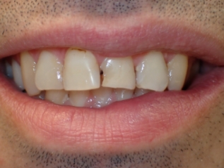 Close up of dull smile with failing restorations