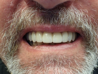 Close up of a much brighter smile