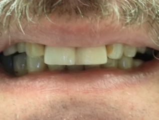 Close up of dull smile with failing restorations