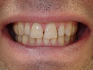 Close up of teeth after veneers have been placed