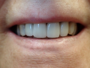 Smile improved by veneers
