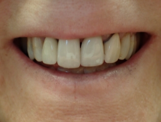 Close up of teeth after veneers have been placed