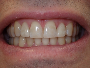 Smile improved by veneers